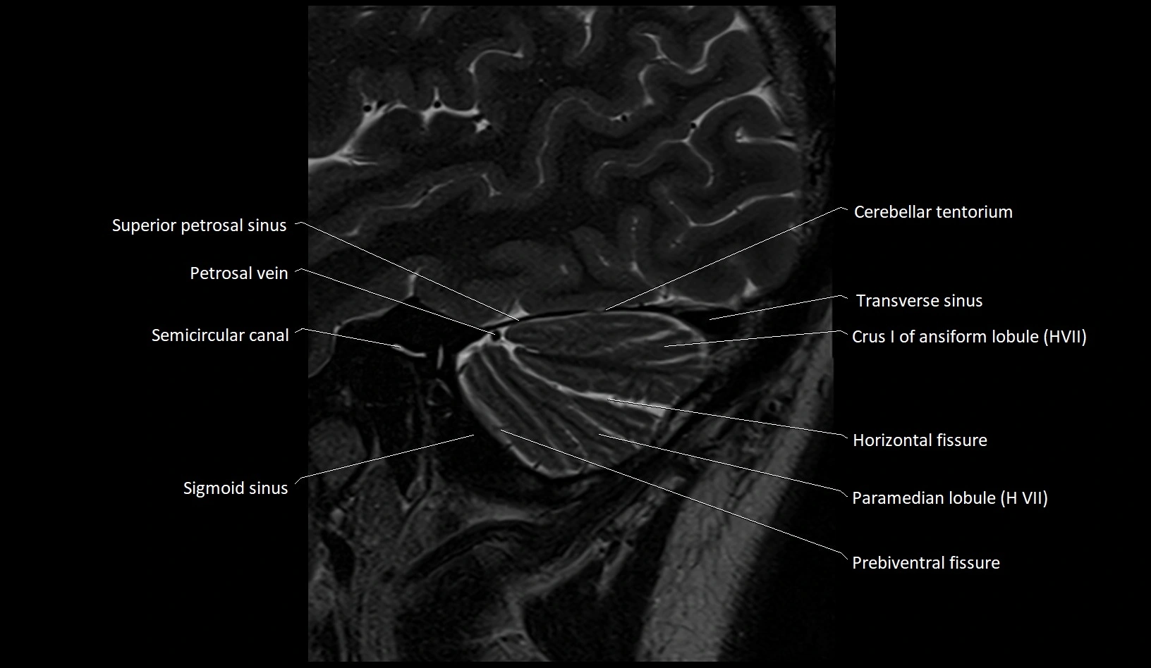 MRI Cerebellar anatomy sagittal High-resolution labelled image 7.webp